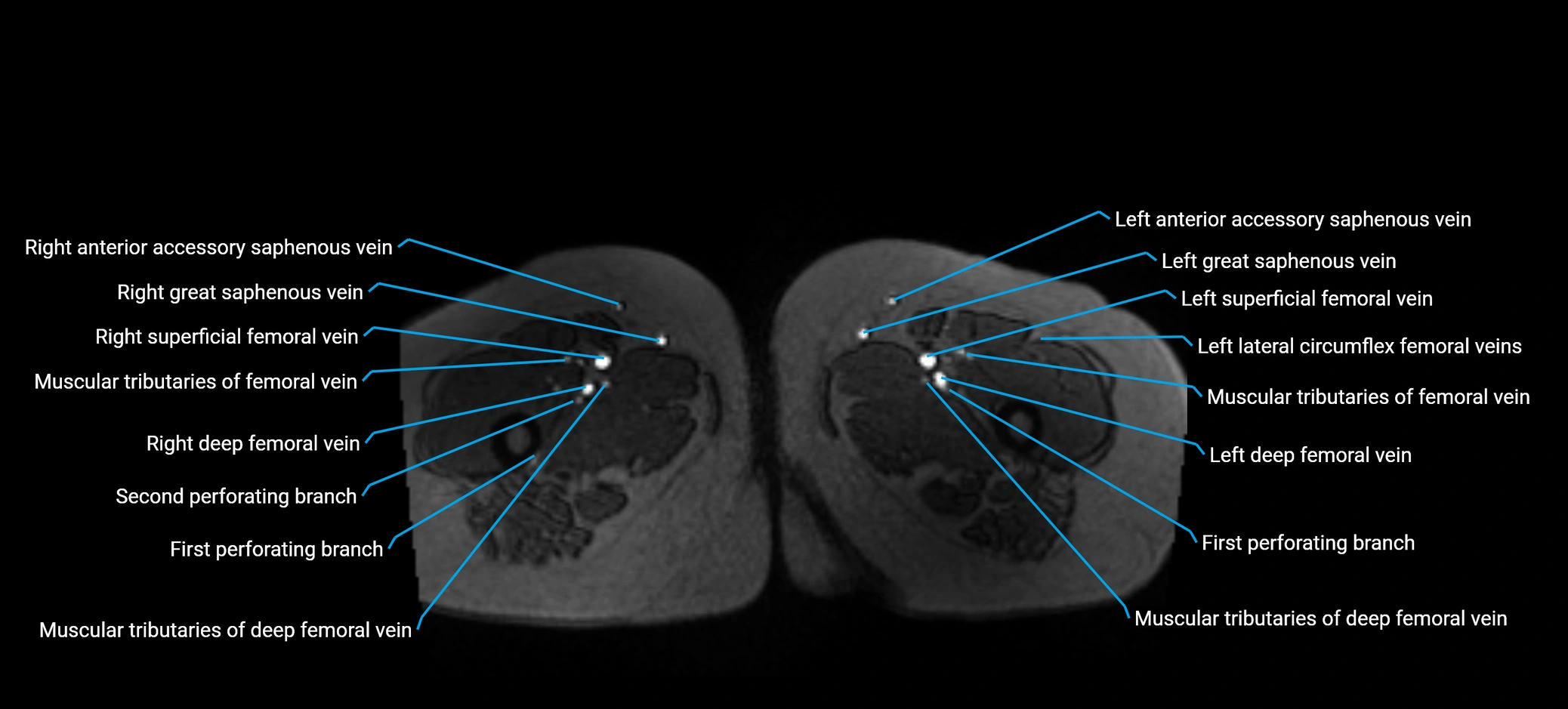 MRV abdomen pelvis & lower limb axial cross sectional anatomy labelled MRI image 222 (1).webp